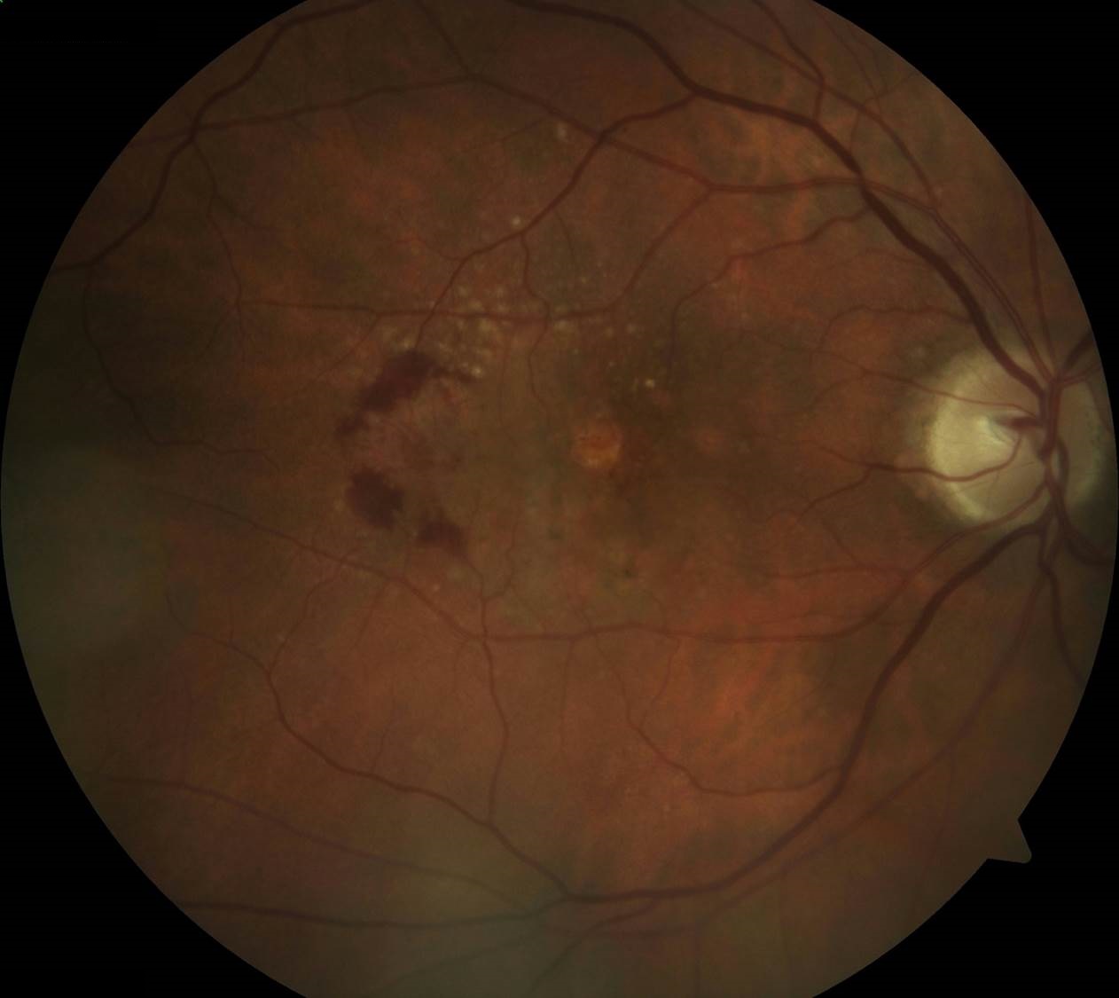 Diabetic Eye Disease