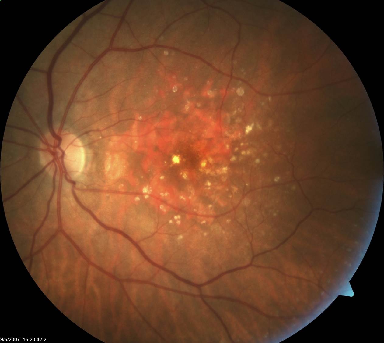 Macular Degeneration